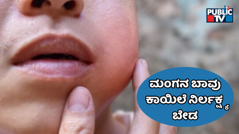 MUMPS DISEASE